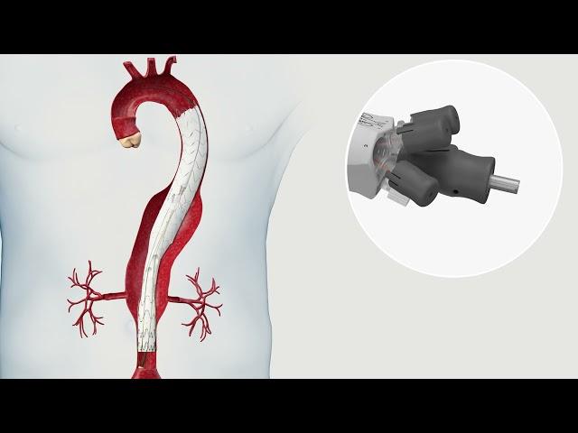 E-nside TAAA Multibranch Stent Graft System Product Animation