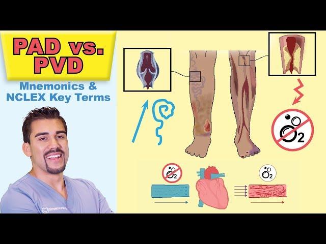 Peripheral Arterial Disease   Top Tested Signs & Symptoms for Peripheral Vascular PAD vs  PVD   Memo