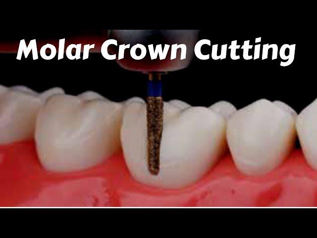 Posterior molar Crown #Tooth_Preparation Cutting For PFM Zirconia Ceramic Emax - Prostho Lecture