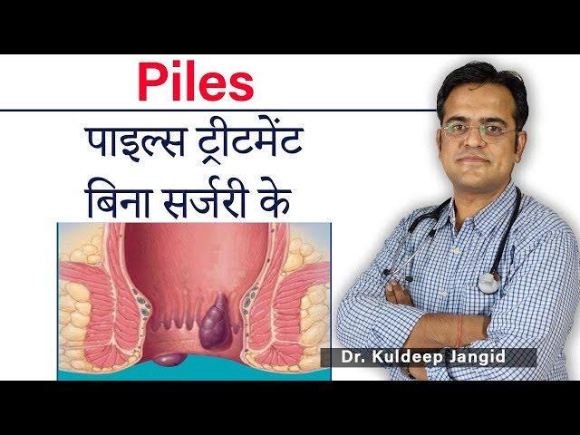 Piles (मस्से/बवासीर)  Permanent Solution | Piles Permanent treatment | Best Treatment of Piles