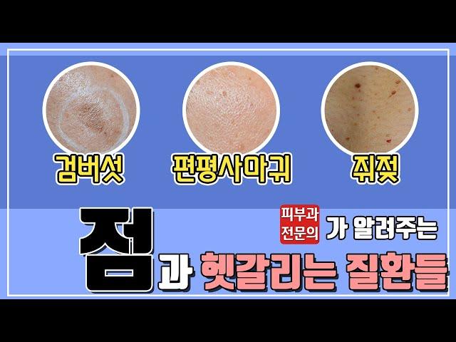 점인줄 알았니? 편평사마귀, 검버섯, 쥐젖