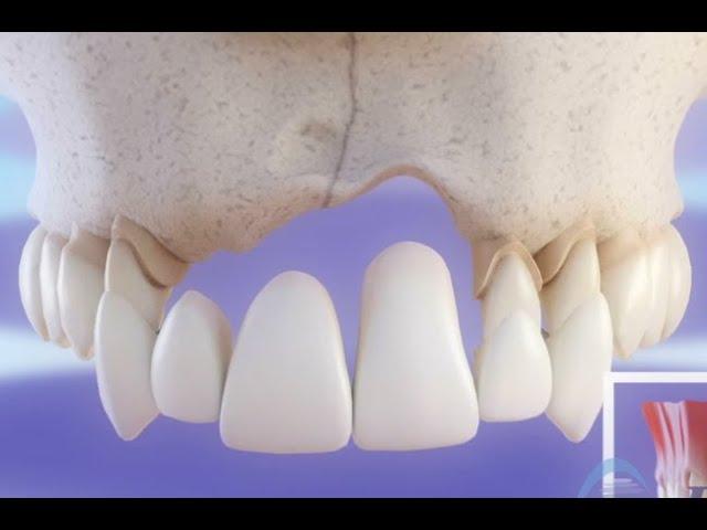 Implant dentaire vs Pont dentaire - Comparaison ©