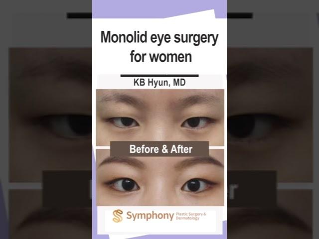 Monolid Eye Surgery for Women! Natural Transformation Plastic Surgery