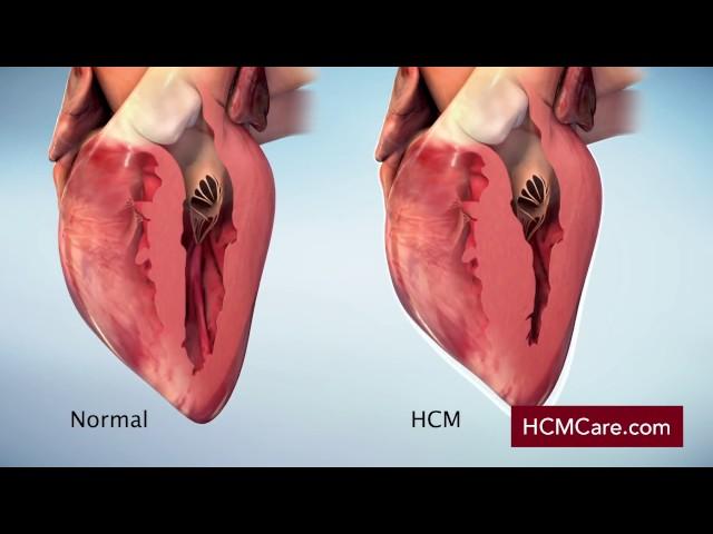 Hypertrophic Cardiomyopathy (HCM) Mechanism of Disease Video