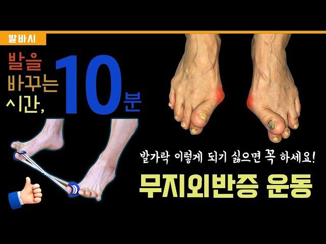 무지외반증에 꼭 필요한 운동 프로그램