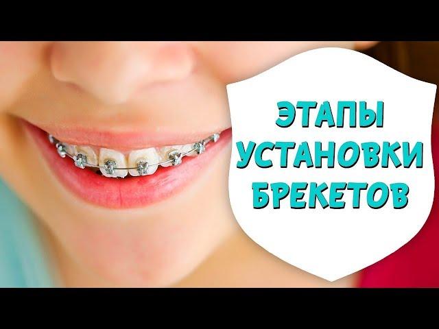 Этапы установки брекетов. Установка металлических брекетов | Доктор Д | Дентал ТВ