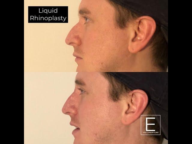 Liquid NoseJob (non-surgical rhinoplasty) with Dr Michael Aicken at East London Clinic