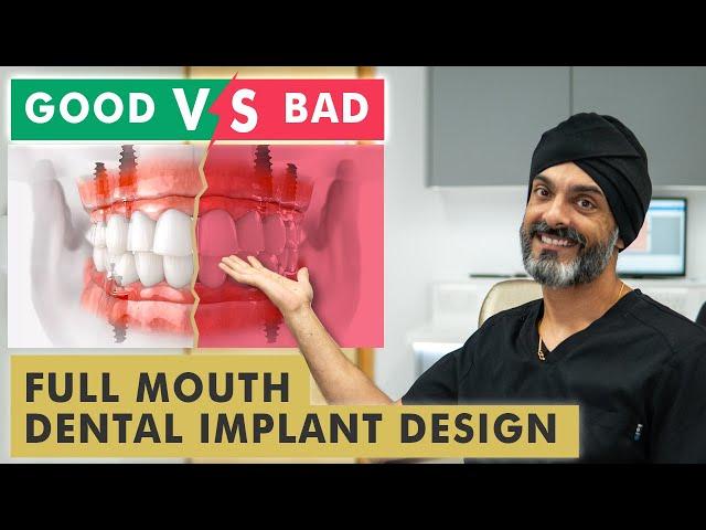 Bad Full Mouth Dental Implant Design vs Good Design - Long Term Effects