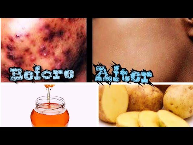 HOW TO GET RID OF ACNE SCARS & HYPERPIGMENTATION NATURALLY AT HOME| 7DAYS