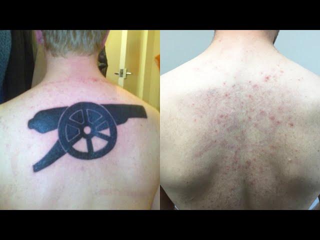 Laser Tattoo Removal -  Does laser tattoo removal hurt?