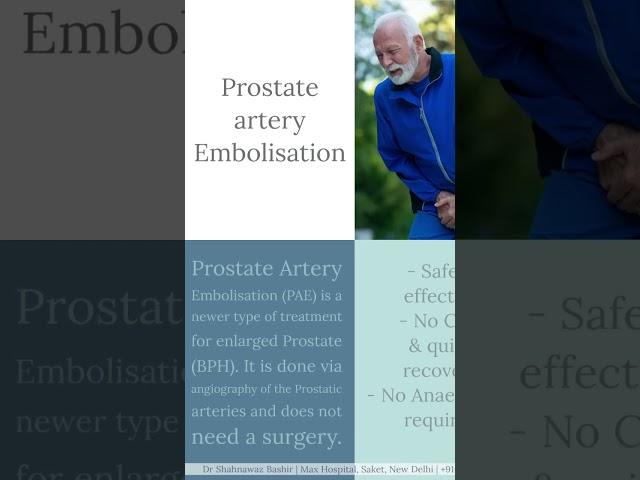 Prostate Artery Embolisation for BPH #Prostate