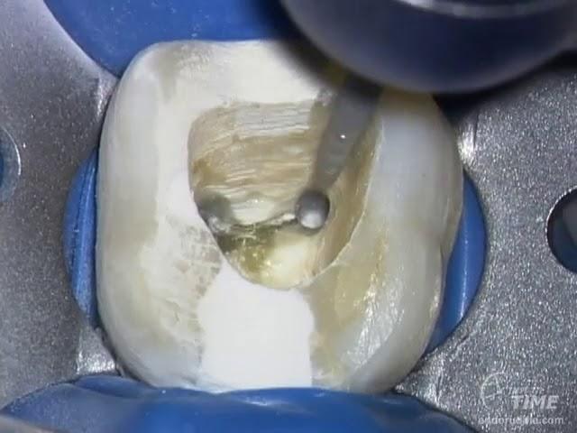 Broken Instrument Removal - Animation & Clinical Op Sequence: Advanced Endodontics