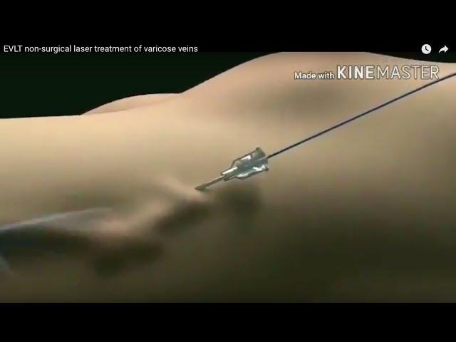 EVLT Laser Treatment for Varicose Veins: The Future of Varicose Vein Treatment Animation Video