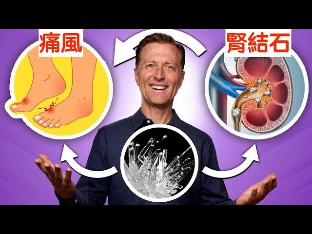 痛風、腎結石與草酸鹽,該吃食物與自然療法預防,柏格醫生 Dr Berg