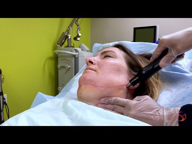 Vaser Liposuction for the Chin