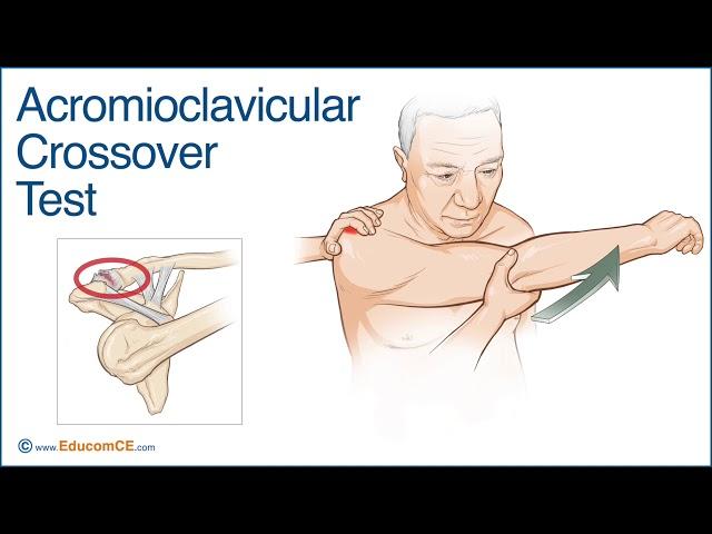 Acromioclavicular Crossover Test - Chiropractic Online CE™