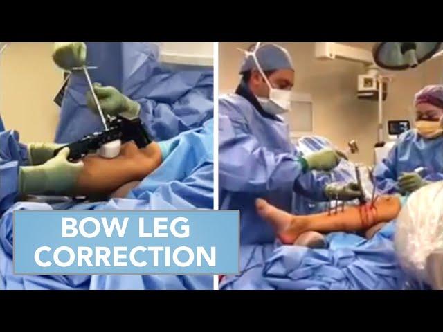 Bow Leg Correction Procedure | Inside the OR with Dr. Mahboubian