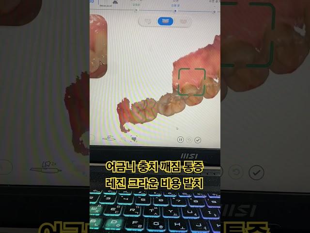 어금니 충치 깨짐 통증 레진 크라운 비용 발치