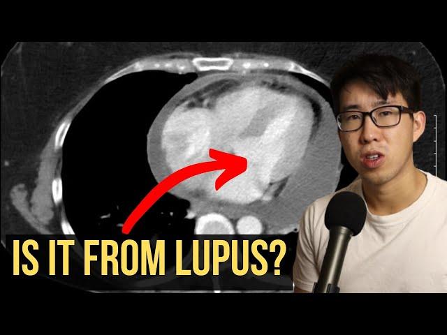 How To Tell If Your Patient Is Having A Lupus Flare