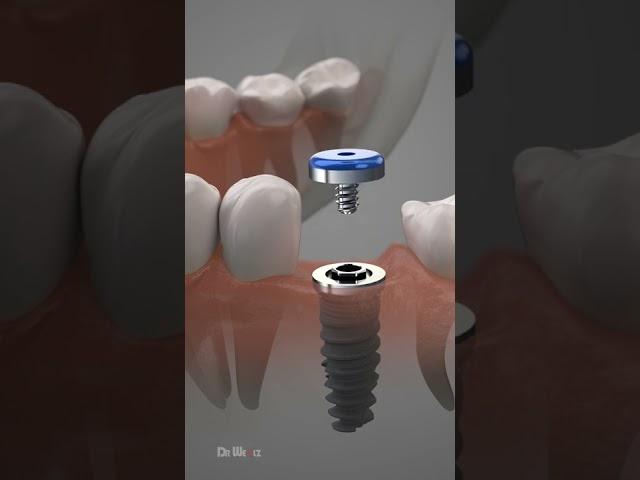 Dental Implant Procedure