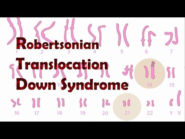 Robertsonian Translocation Down Syndrome (ROB)