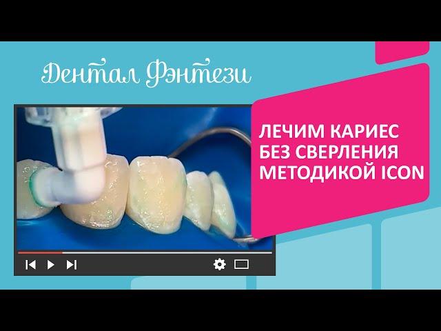  Лечим кариес без сверления методикой ICON