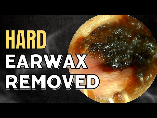 SOLID Hard Earwax Removed After Weeks