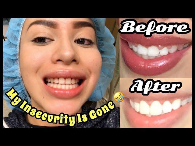 I GOT SURGERY?! | CROWN LENGTHENING EXPERIENCE