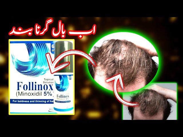 hair loss solution || #minoxidil ||  2% , 5% , 10% #ImMEDICAL