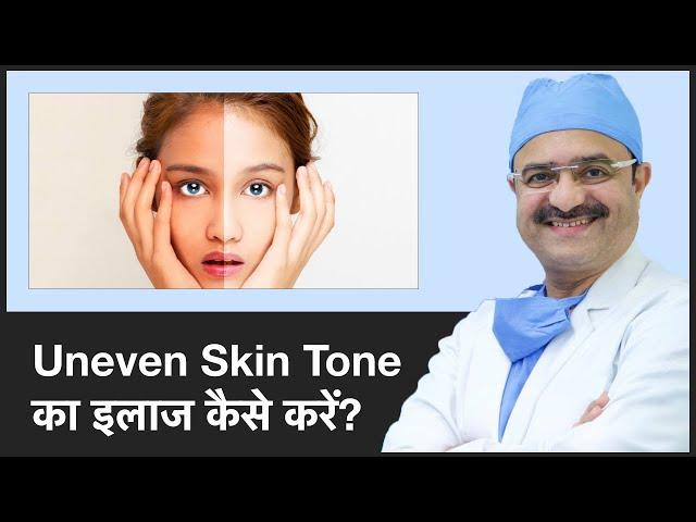 How To Treat Uneven Skin Tone (Uneven Skin Tone का इलाज कैसे करें) | ClearSkin, Pune | (In HINDI)