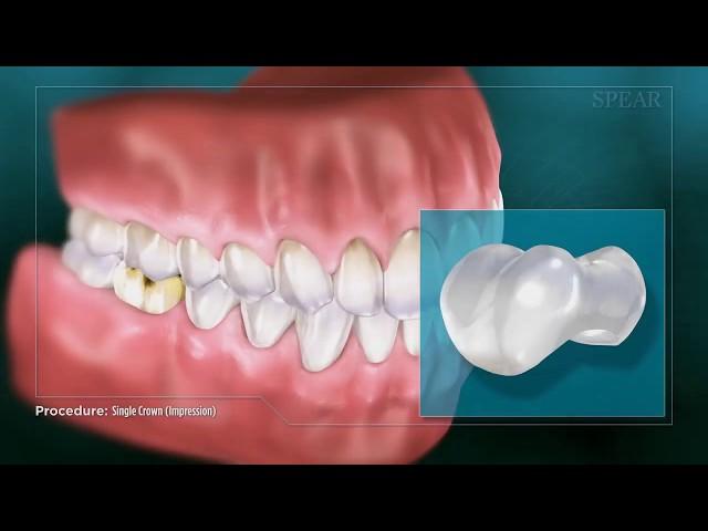 Dental Crown