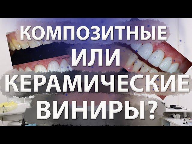 Композитные виниры или керамические