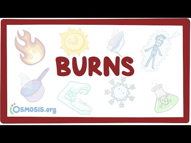 Burns - an Osmosis Preview