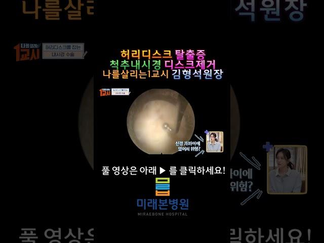 터진 허리 디스크 척추 내시경으로 제거#shorts #허리디스크#척추내시경#김형석#나를살리는1교시#추간판탈출증#추간판절제술#미래본병원#단일공척추내시경#단방향척추내시경#미래본병원#