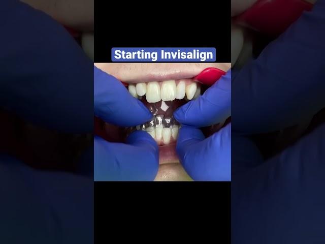 Adult Invisalign