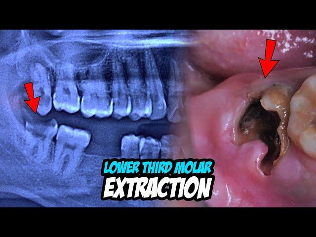 Molar Tooth Extraction Procedure | Dentist | Dokter Gigi Tri Putra