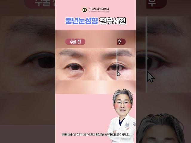 중년눈성형하면 눈매가 사나워진다?? NO! #상안검 #하안검 #눈썹거상술 #눈밑지방