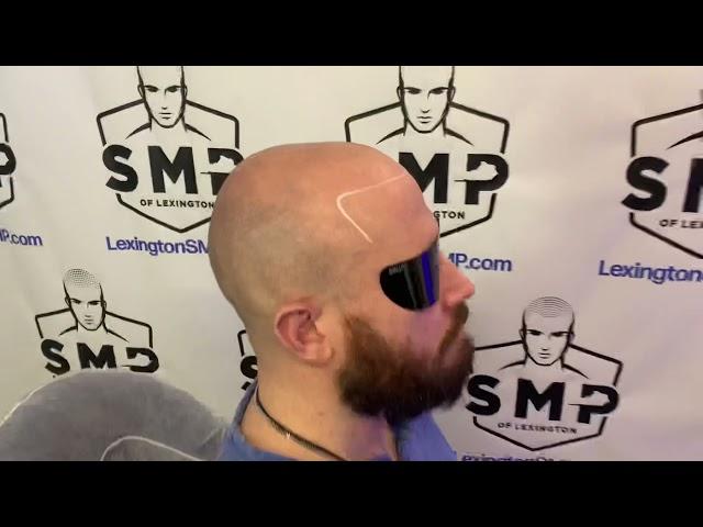 Scalp Micropigmentation - Central KY