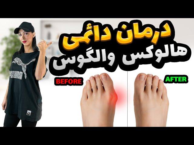 روش درمان هالوکس والگوس | درمان قوز شست پا | hallux valgus