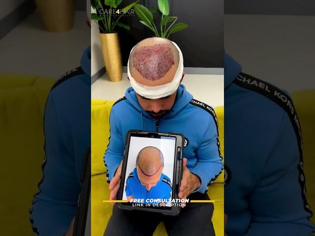 Patient after his hair transplant in Miami  | Care4Hair