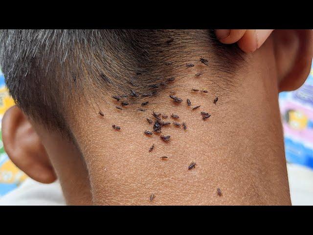 Get out all lice from his black hair - Remove all hundred lice from head