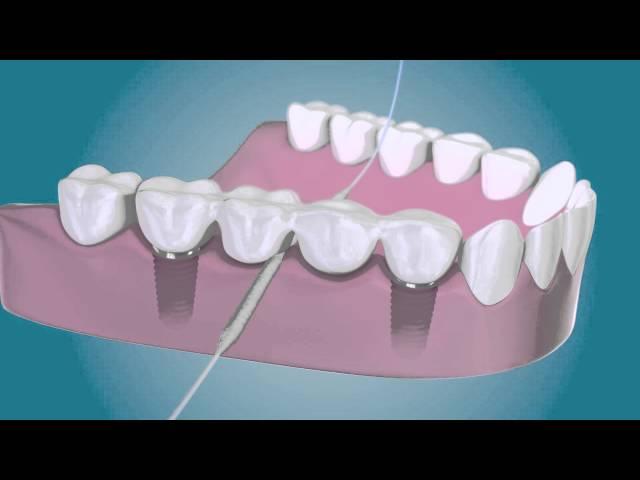 Nettoyez autour de vos implants dentaires avec TePe Bridge & Implant Floss