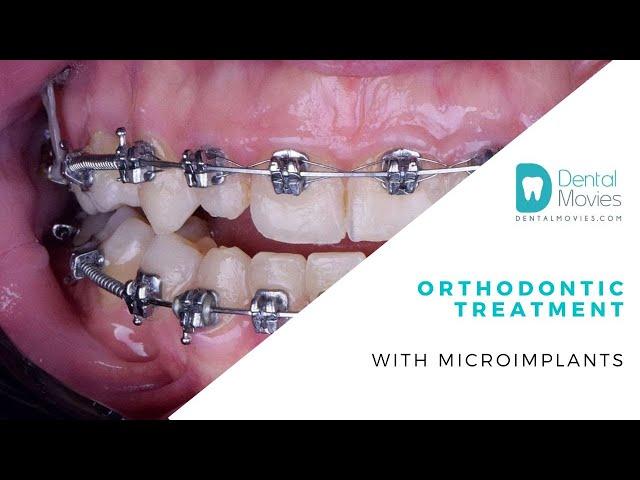 Orthodontic treatment with microimplants