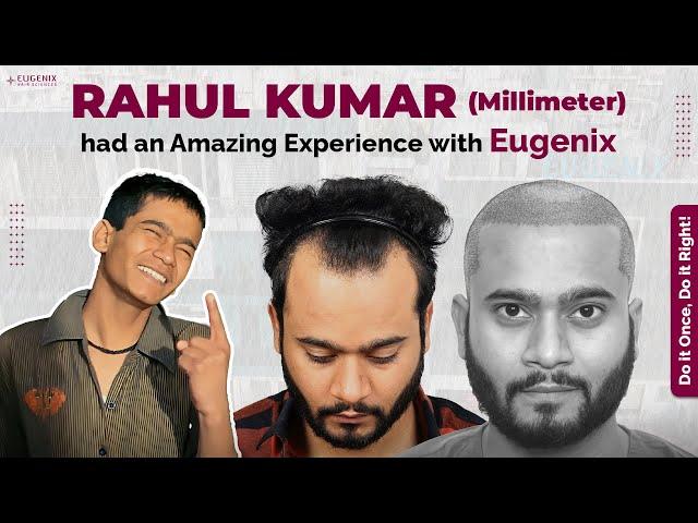 3 Idiots fame Film Actor Rahul Kumar's Hair Loss at 29 years and Hair Transplant Journey at Eugenix