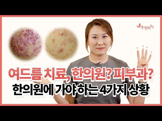 여드름 치료, 이 경우엔 무조건 한의원으로 가세요