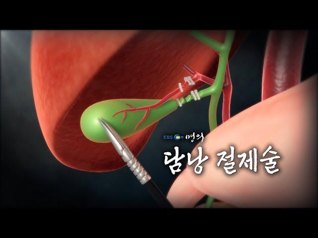 [명의 의학백과] 담낭 절제술