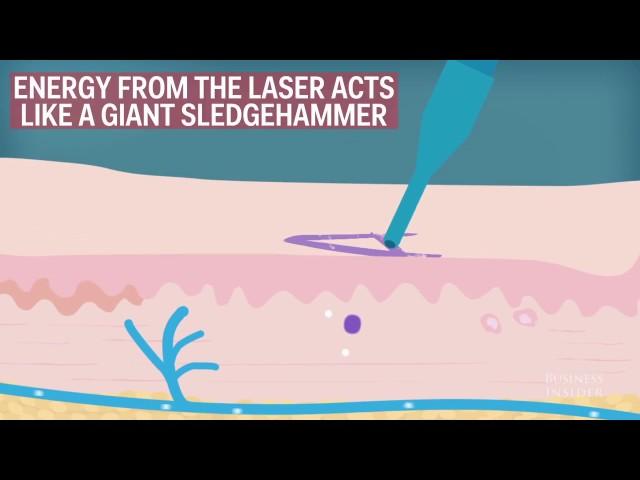 How Laser Tattoo Removal Works- Business Insider