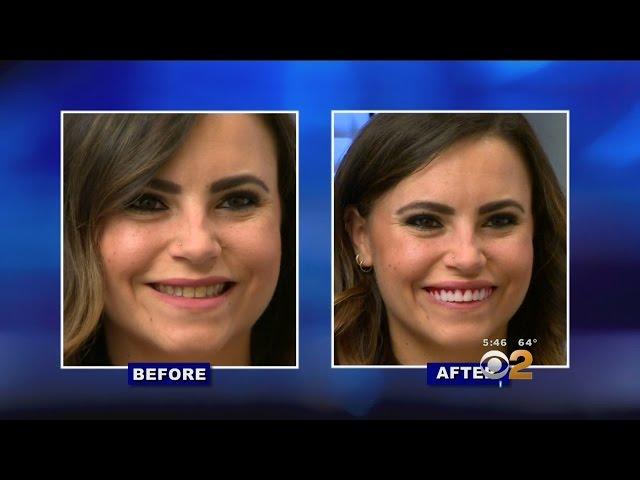 As Seen On TV: 'Perfect Smile Veneers' Not So Perfect