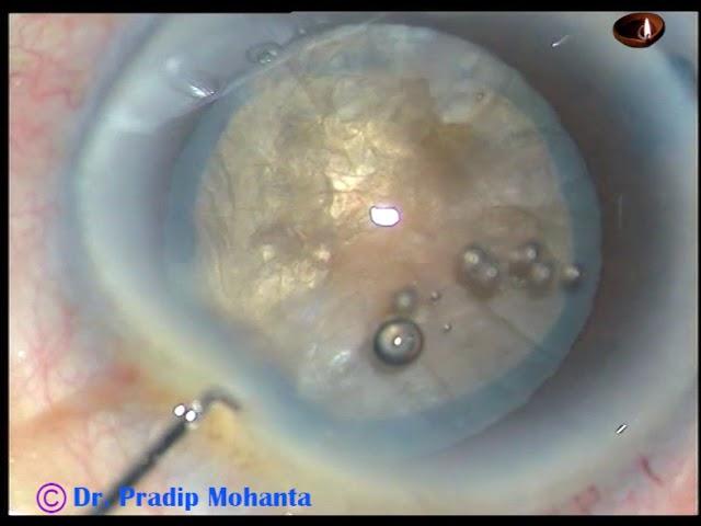 Management of an Intumescent Cataract with HARD Nucleus - PM, 12/9/2018