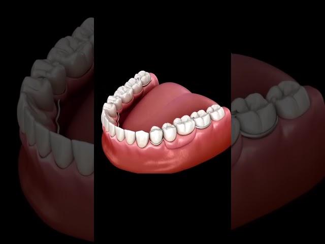 Partial Denture | Dentist in indore | Dental clinic in indore